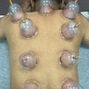 Image 2: Release Toxins. Relieve Pain. Revive Your Body — wet cupping therapy