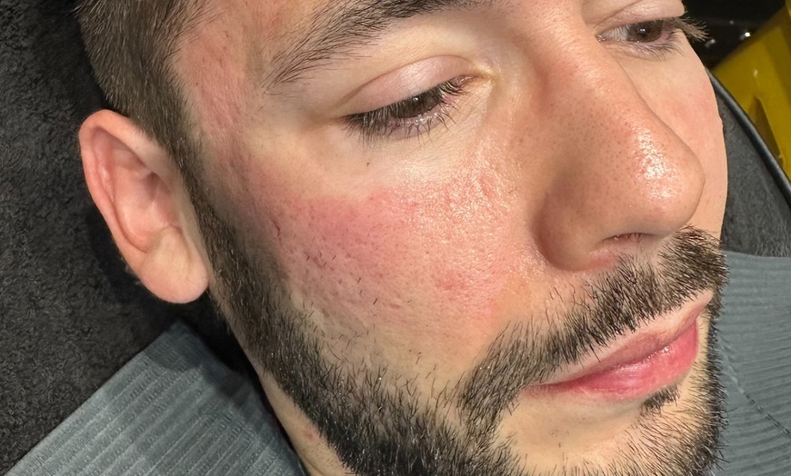 Image 6: Microneedling with Derma 2.0: 1 or 3 Skin-Revitalising Sessions