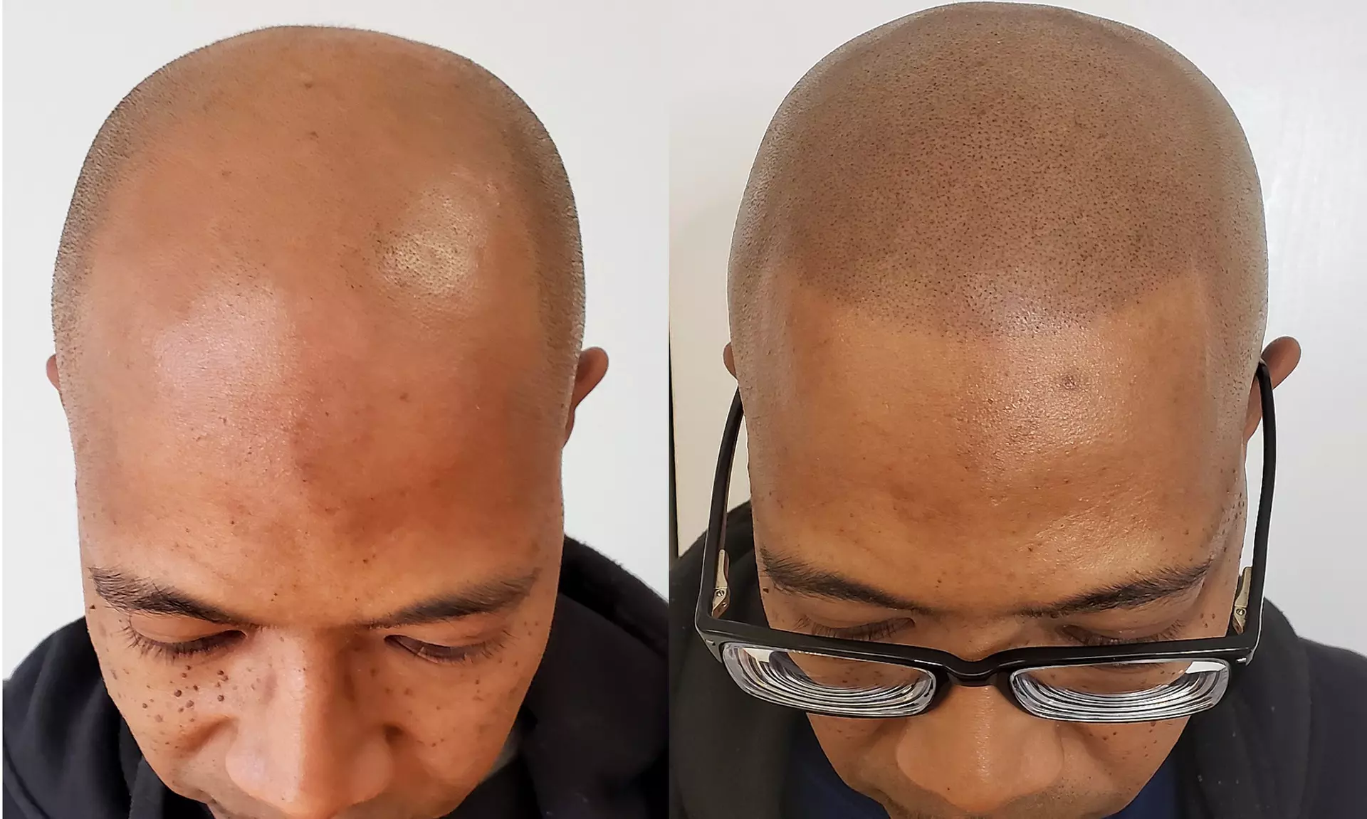 Crown, Half, or Full Scalp Micropigmentation at Illusion Scalp Micropigmentation (Up to 51% Off) - Primary Image