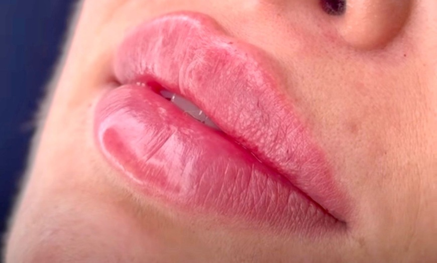 Image 2: Bis zu 63% Rabatt auf den Injektionsbehandlung – Hyaloronsäure bei SoFi Aesthetik