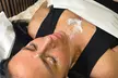 Up to 64% Off on Facial - Peeling at Jems Laser & Aesthetics Liverpool Limited - Second Medium