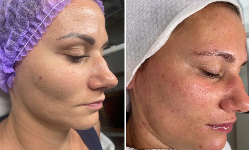 Image 2: One session I-PRF Microneedling at Étoilée Aesthetics