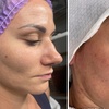 Image 2: One session I-PRF Microneedling at Étoilée Aesthetics