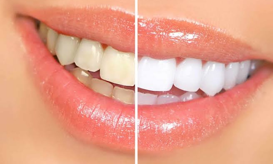 Image 1: Brighter Smiles: 1–3 Professional Teeth Whitening Sessions 