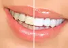 One, Two, or Three Teeth Whitening Treatments for a Radiant Smile at The House Of Body sculpting Up To  63% Off