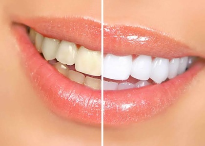 One Teeth Whitening Treatment Brite Smile - The House Of Body sculpting