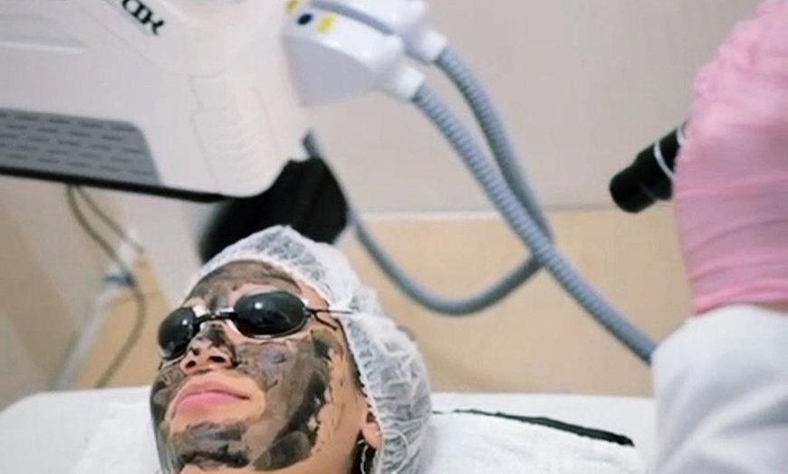 Image 2: Depilación láser, peeling Hollywood y láser de picosegundos 