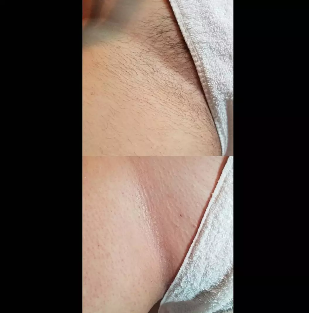 Smooth Skin Awaits with Bikini, Deep Bikini or Brazilian Sugaring