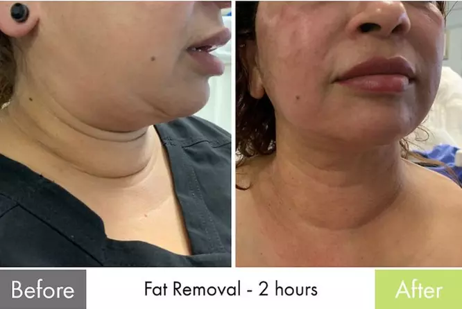 Transform Your Body: 1 or 3 Non Invasive Non Surgical Tripollar Lipo