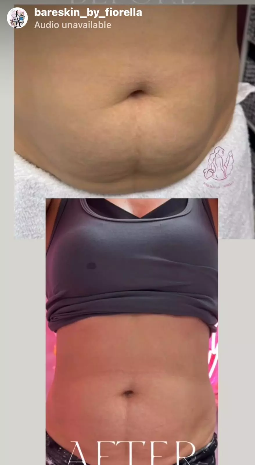 Smoother Contours with One or Two Non Invasive Laser iLipo + Cavitation & Wood Therapy @Bare Skin (Up to 87%Off) - Second Medium