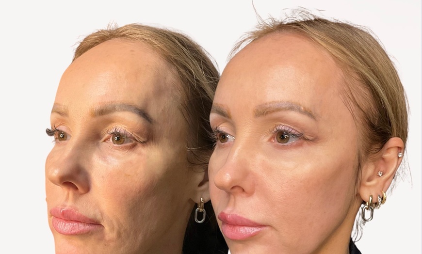 Image 5: Up to 40% Off Dermal Filler at Hush Aesthetics, LLC