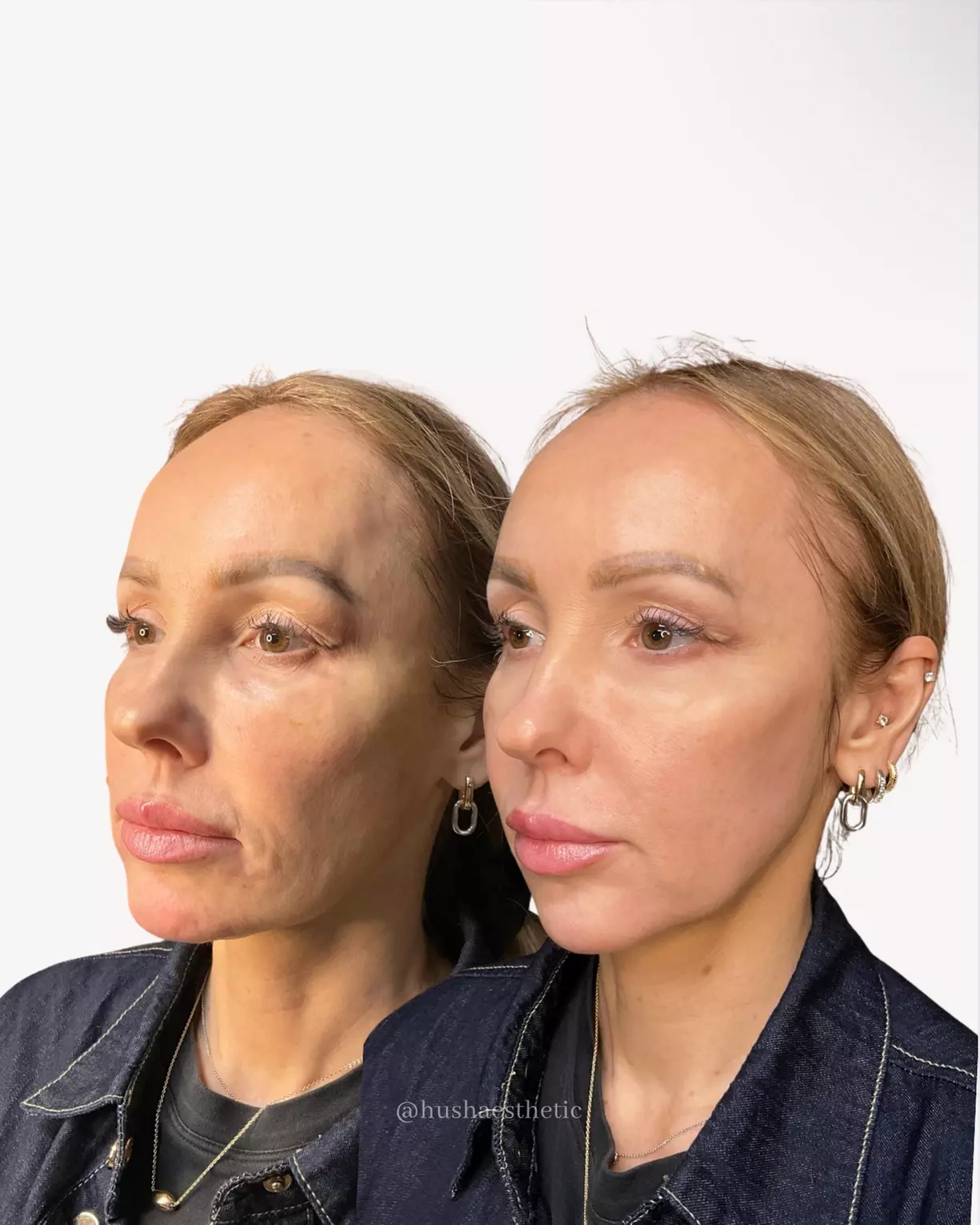 Up to 43% Off Dermal Filler at Hush Aesthetics, LLC