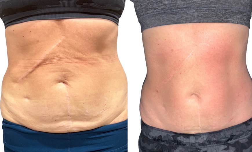 Image 2: Transform Your Body with T-Shape 2 Body Contouring Intro Session