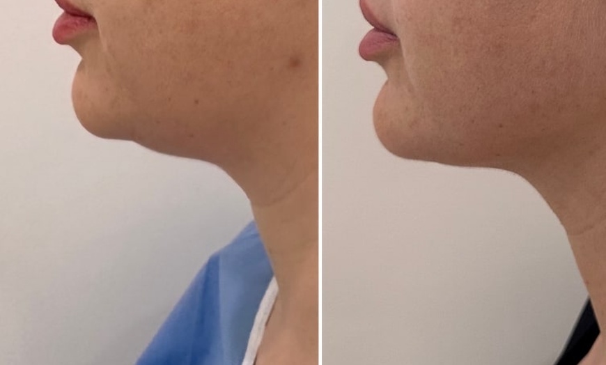 Image 5: Transform with Lemon Bottle Fat Dissolving on Face or Body