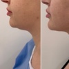 Image 5: Transform with Lemon Bottle Fat Dissolving on Face or Body