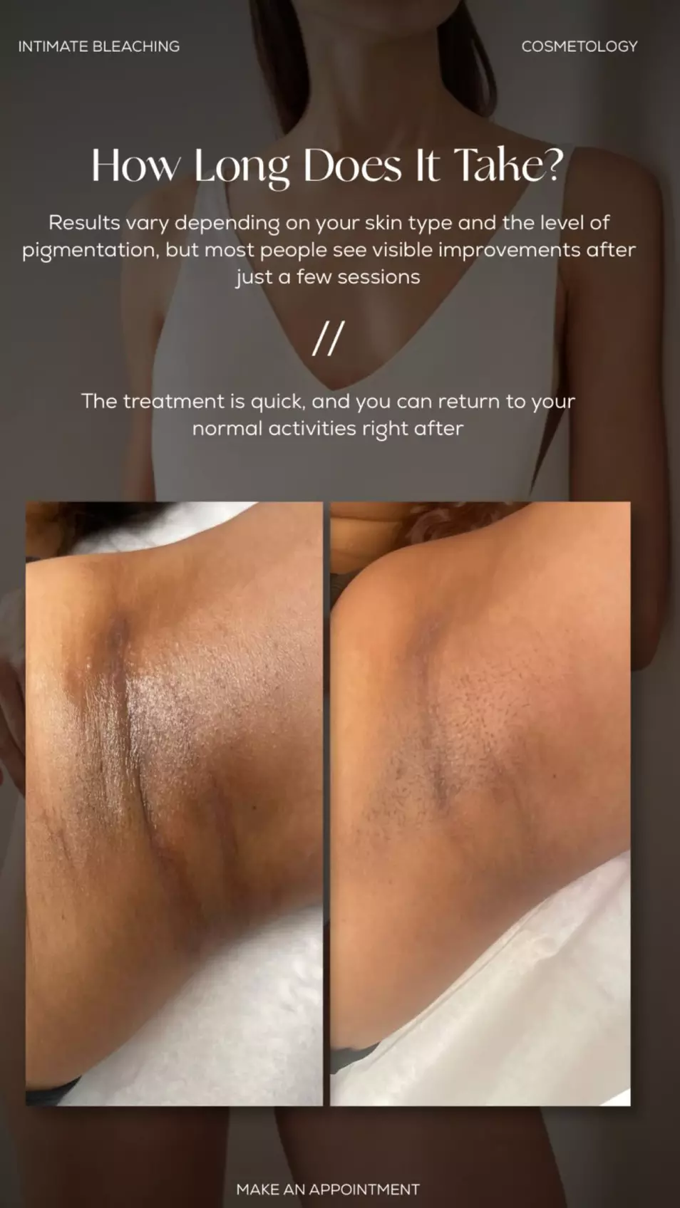 Discreet and Effective Intimate Bleaching at W Laser: Up to 40% Off Intimate Bleaching - Second Medium