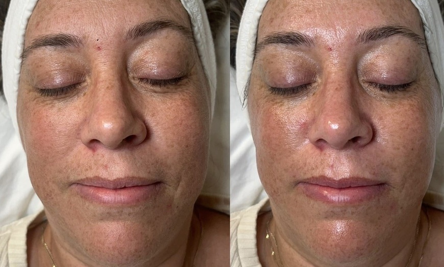 Image 3: Reveal Fresh Skin with One Dermaplane Facial Treatment
