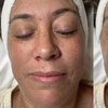 Image 3: Reveal Fresh Skin with One Dermaplane Facial Treatment
