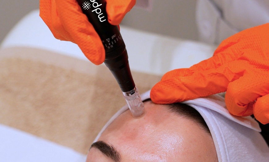Image 6: One or Two Micro-Needling Sessions with Optional PDGF Treatments