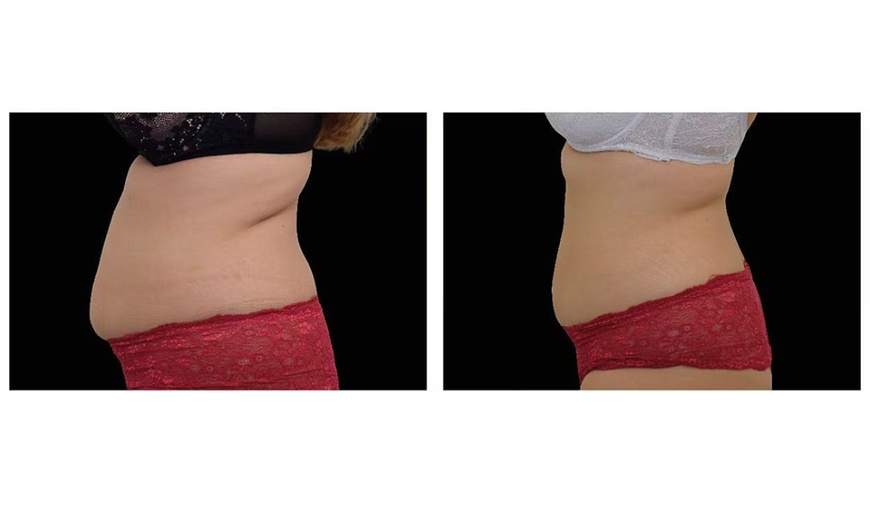 Image 5: One Session Electromagnetic Body Sculpting on One, Two or Four Areas