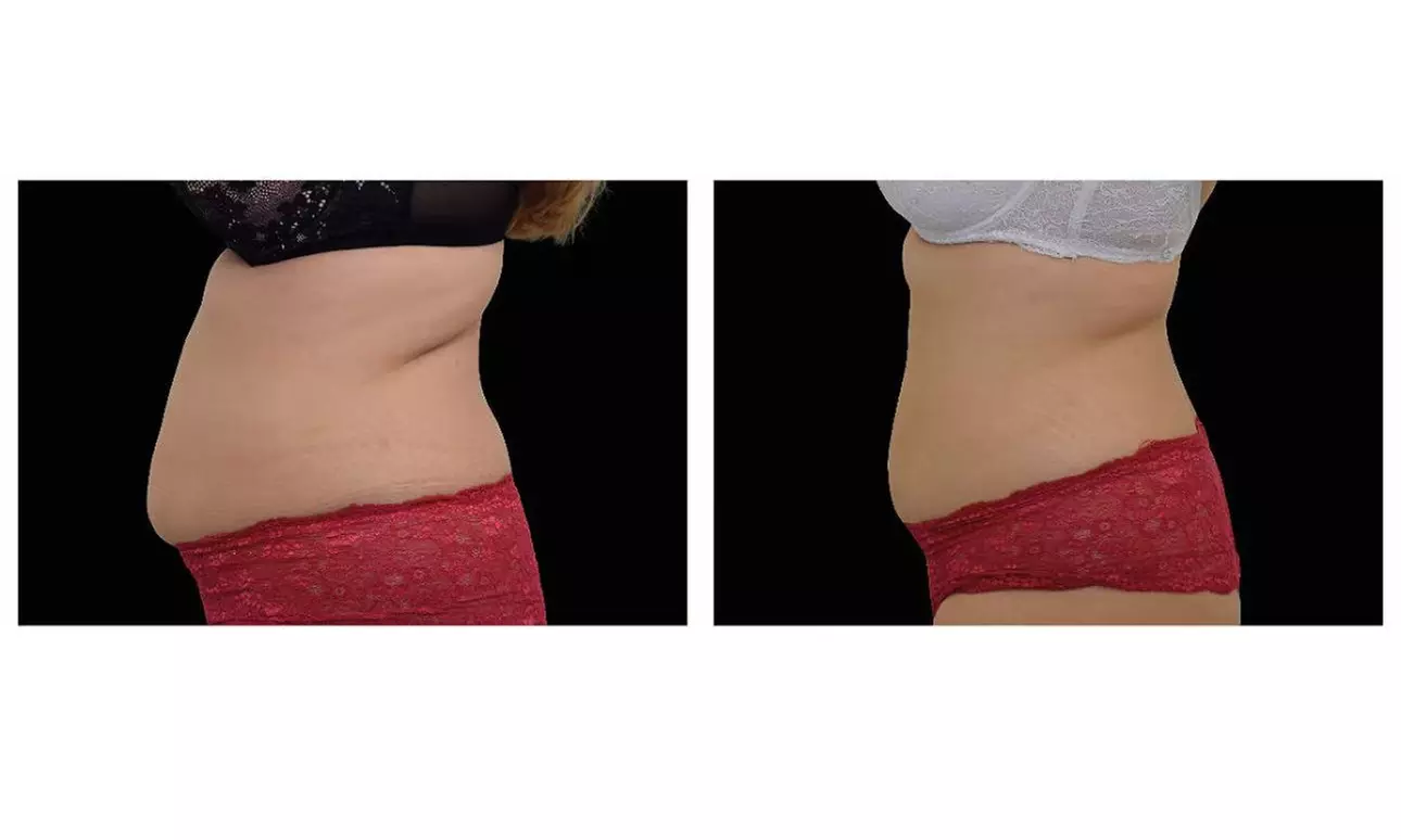 One Session Electromagnetic Body Sculpting on One, Two or Four Areas at Muses Beauty Boutique - Second Medium