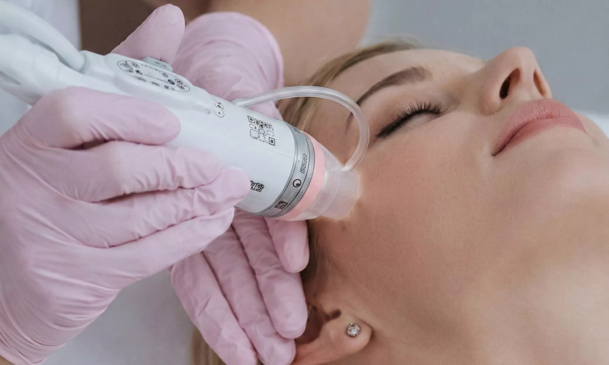 1 or 3 RF Microneedling Skin Rejuvenation Treatments