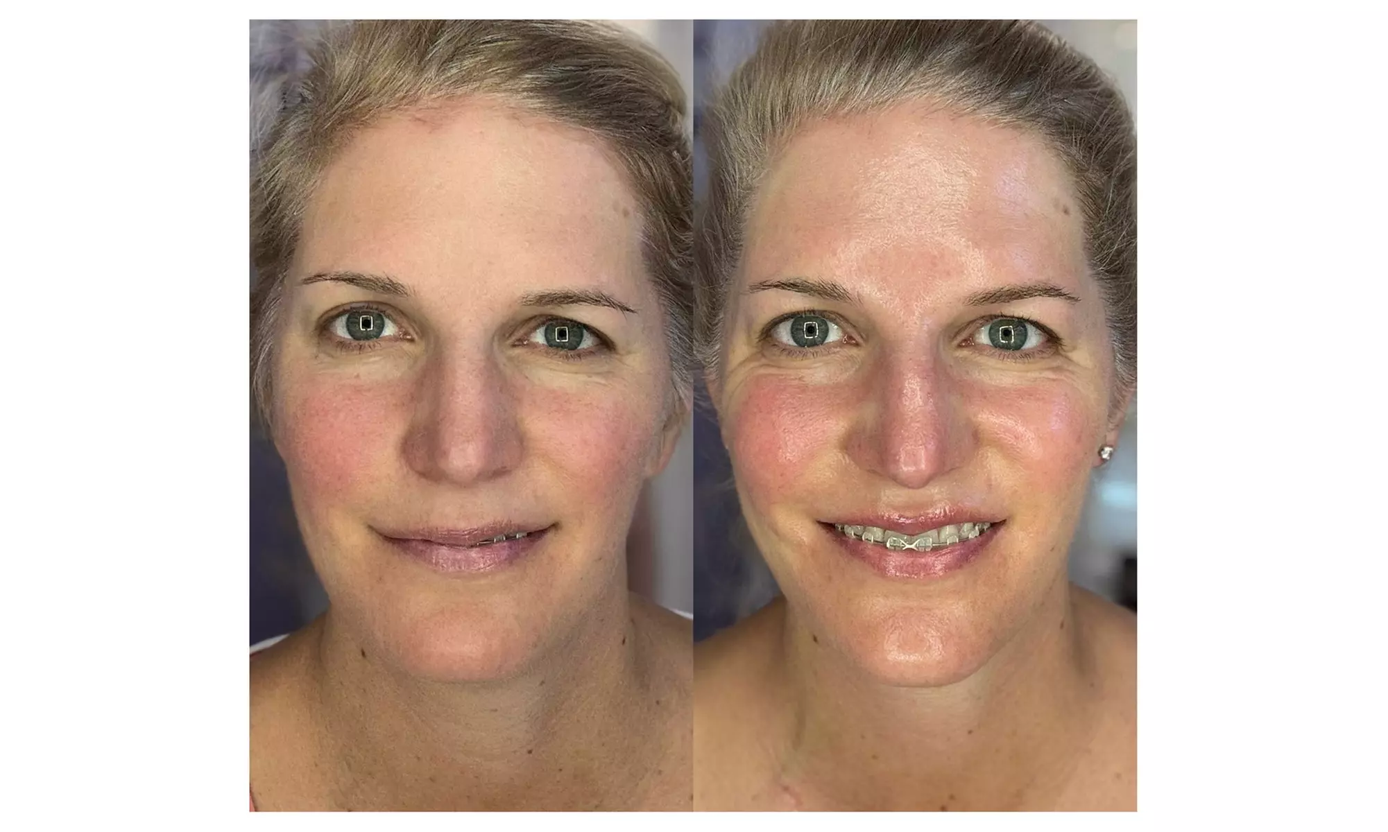 Tone with Five Sessions of Body Sculpting - Small or Large Area