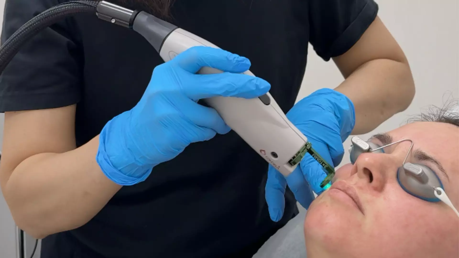 Rejuvenate your Complexion with One V-Beam Laser Therapy!