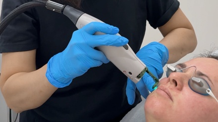 One V-Beam Treatment - Zavant Aesthetics