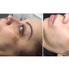 Image 2: Experience IPL Photofacial for Skin Renewal