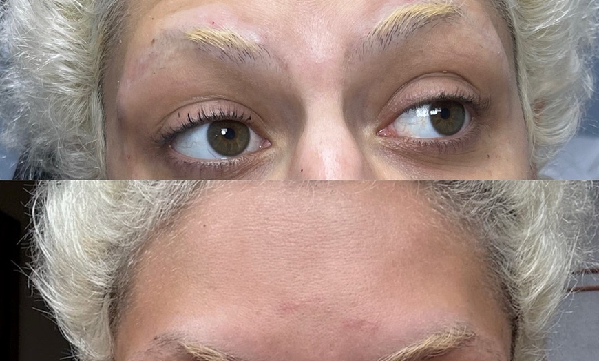 Image 4: Refresh Your Skin with 20, 40, or 60 Units of Neurotoxin