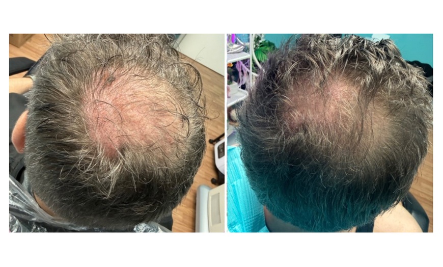 Image 6: Up to 54% Off on Hair Restoration - Non-Surgical at Aesthetics Care Med Spa