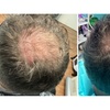 Image 6: Up to 54% Off on Hair Restoration - Non-Surgical at Aesthetics Care Med Spa