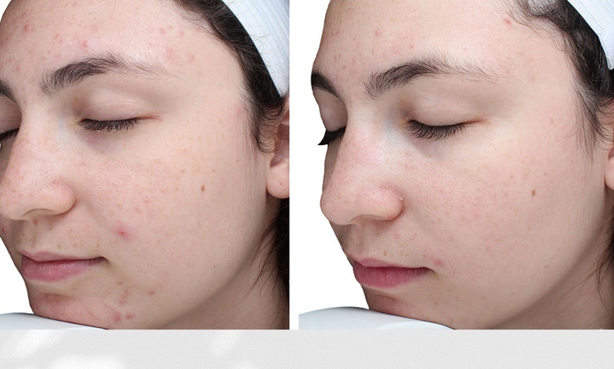 Image 5: VI Original, Purify or Advanced Peel with LED Light Therapy