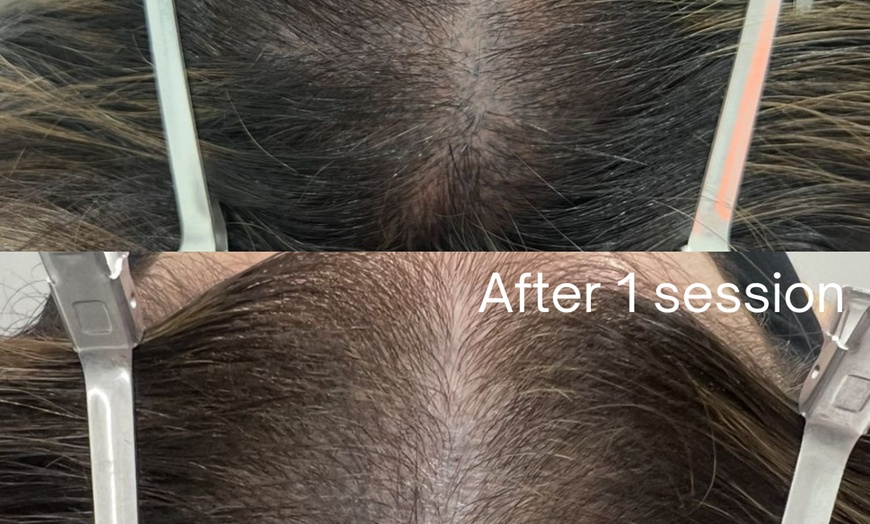 Image 5: 30-Minute One, Two, or Three Alma TED Hair Restoration Sessions
