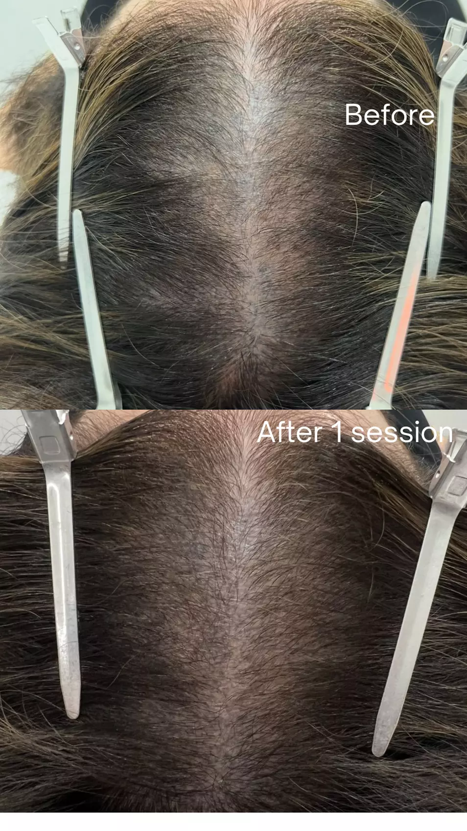 30-Minute One, Two, or Three Alma TED Hair Restoration Sessions