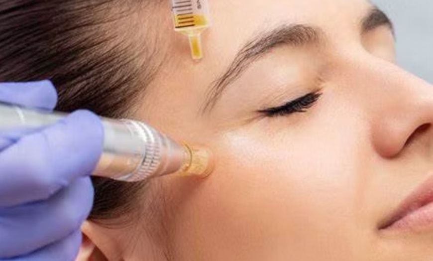 Image 1: Reveal Your Natural Glow PRP Facials & Hair Rejuvenation @ A+ Day Spa