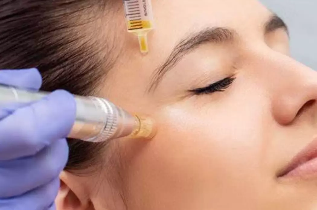 Reveal Radiant Skin Naturally with PRP & Microneedling at A+ Day Spa - Primary Image