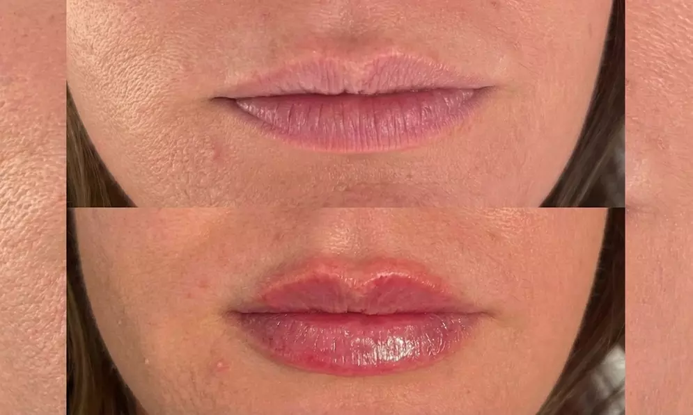 Get 40 or 100 Units of Dysport Injection Wrinkle Reduction Treatments