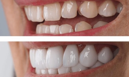 Option 1: 1 Ceramic Veneer - Your Covina Family Dentistry