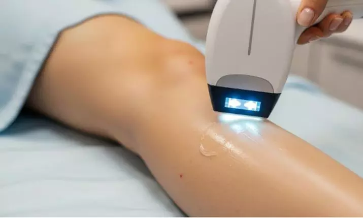 One, Two or Three Sessions of IPL Hair Removal for Choice of Areas