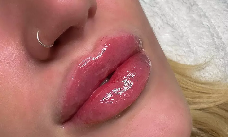 Enhance Your Natural Beauty with Dermal Filler Treatments