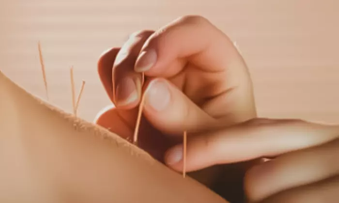 Acuwave Signature Balance™ Full-Body Balancing Acupuncture