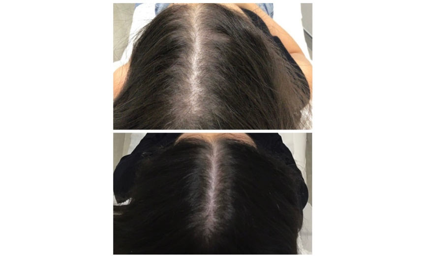 Image 3: One, Two, or Three Sessions of  PRP Hair Growth Treatment 