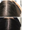Image 3: One, Two, or Three Sessions of  PRP Hair Growth Treatment 