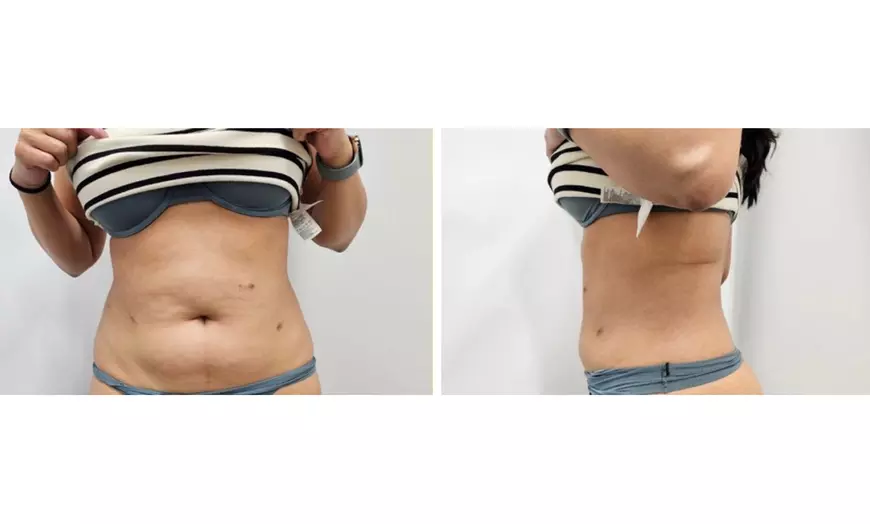 Image 6: Enjoy Pressotherapy Lymphatic Massage, RF Tightening, or Cavitation!