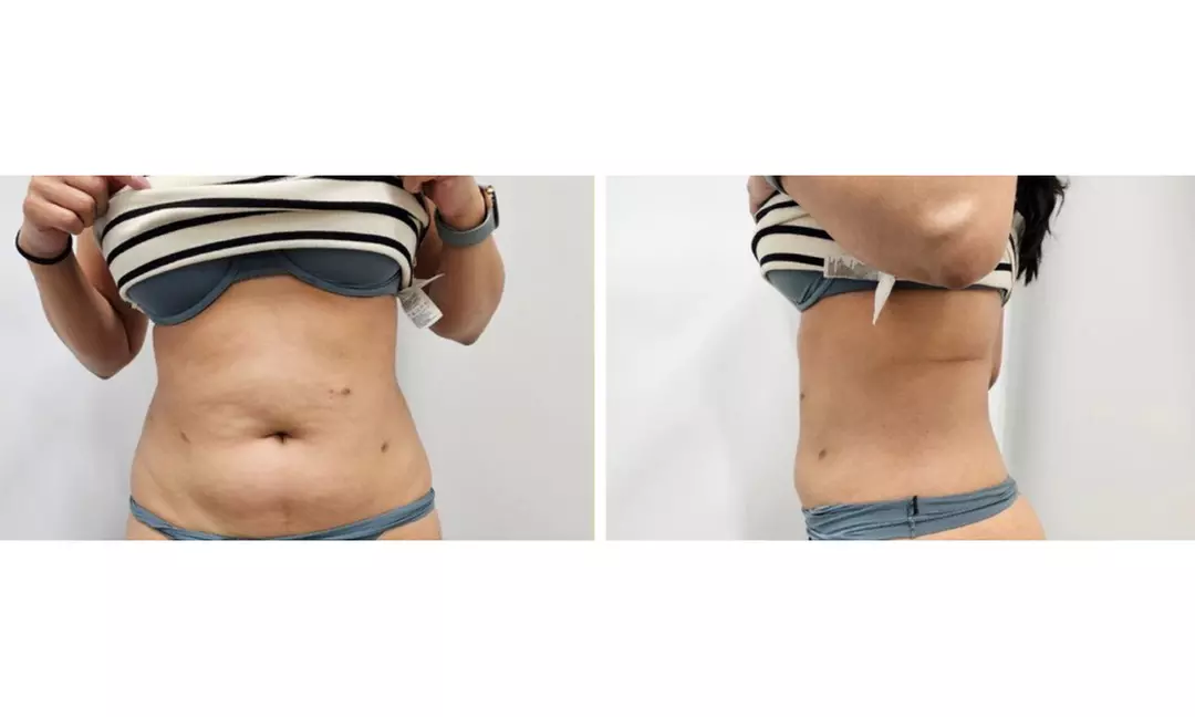 Enjoy Pressotherapy Lymphatic Massage, RF Tightening, or Cavitation!