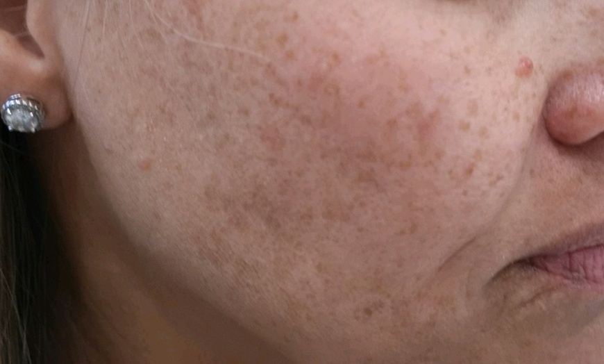 Image 3: Revitalize Your Skin with IPL Photofacial Treatments