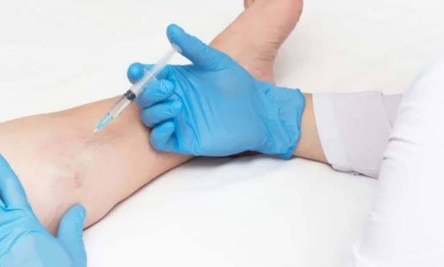 Image 3: 1 or 3 Vials of Sclerotherapy for Vein-Free Legs
