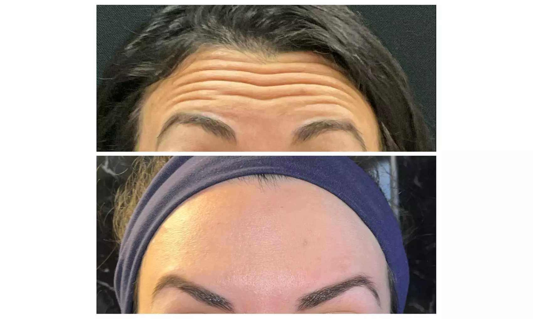 Glow Naturally w/ 20, 40, or 60 Units of Xeomin or Jeuveau